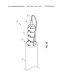 PERCUTANEOUS ANNULOPLASTY SYSTEM WITH ANTERIOR-POSTERIOR ADJUSTMENT diagram and image