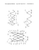 IMPLANTABLE VASCULAR DEVICE diagram and image