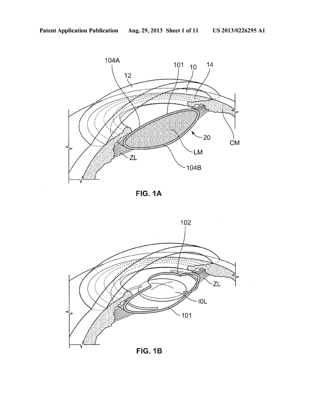 Intraocular, Accommodating Lens And Methods Of Use - diagram, schematic, and image 02