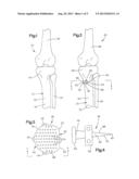 WEDGE APPARATUS FOR USE IN OPERATING ON A BONE diagram and image