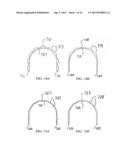 APPARATUS FOR ORTHODONTIC ALIGNER TRAY RETENTION diagram and image