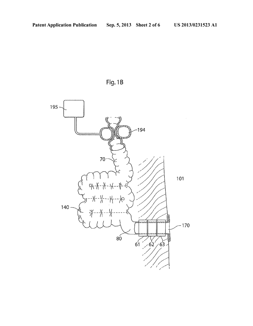 SYSTEM FOR TREATING A PATIENT HAVING AN INTESTINAL DISORDER - diagram, schematic, and image 03