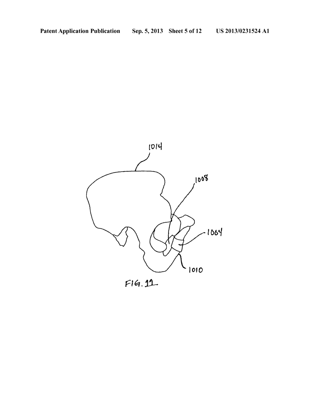 Implantable sling for the treatment of incontinence and method of using     the same - diagram, schematic, and image 06