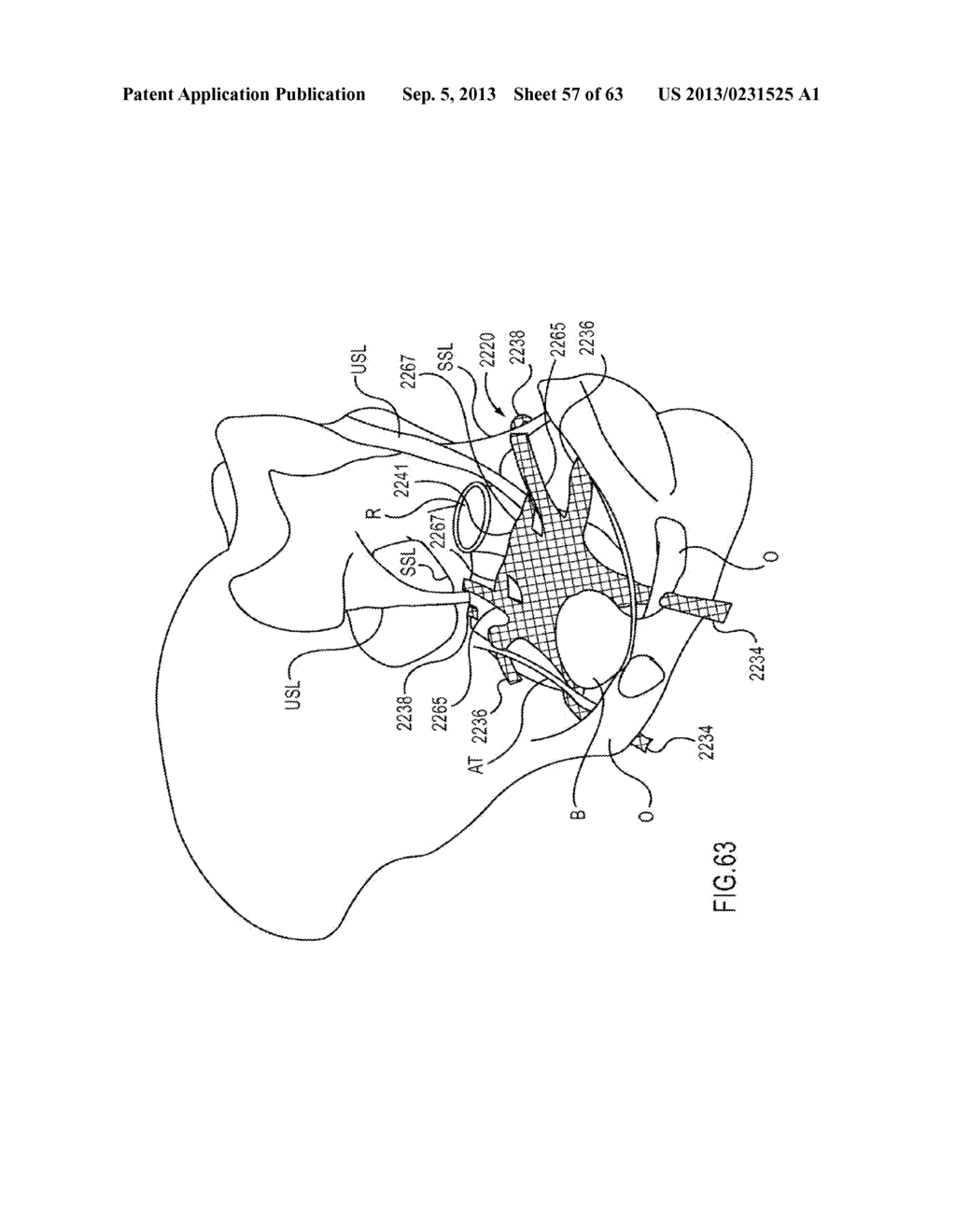 DEVICES AND METHODS FOR TREATING PELVIC FLOOR DYSFUNCTIONS - diagram, schematic, and image 58