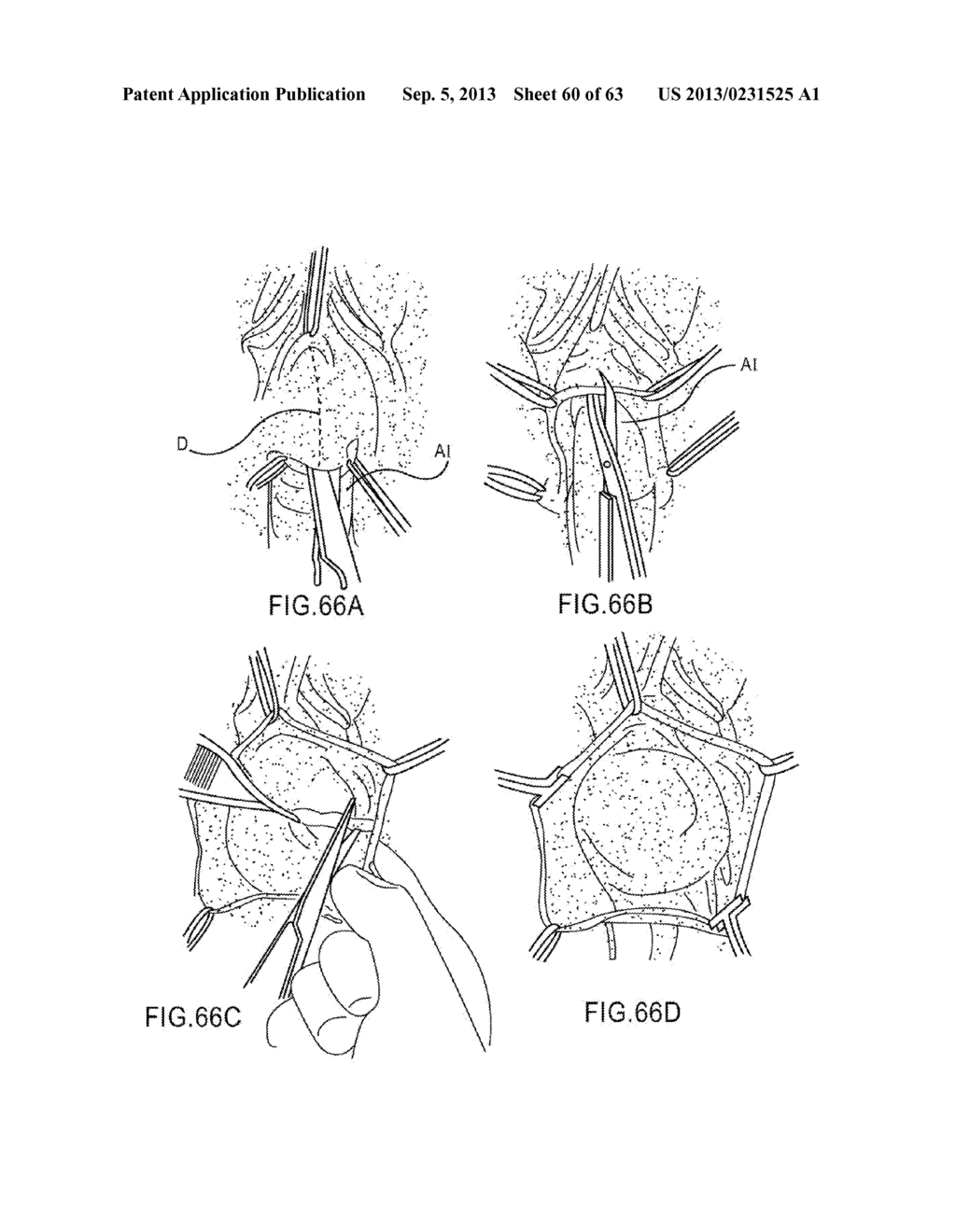 DEVICES AND METHODS FOR TREATING PELVIC FLOOR DYSFUNCTIONS - diagram, schematic, and image 61