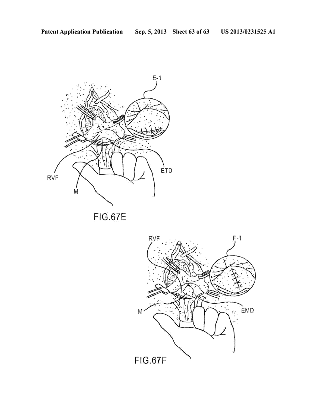 DEVICES AND METHODS FOR TREATING PELVIC FLOOR DYSFUNCTIONS - diagram, schematic, and image 64