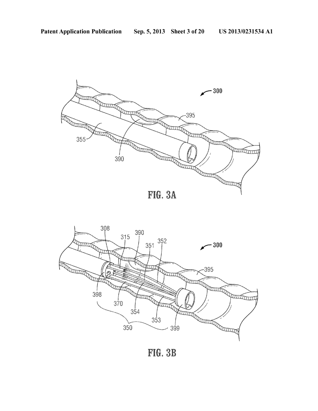 FLOATING, MULTI-LUMEN-CATHETER RETRACTOR SYSTEM FOR A MINIMALLY-INVASIVE,     OPERATIVE GASTROINTESTINAL TREATMENT - diagram, schematic, and image 04