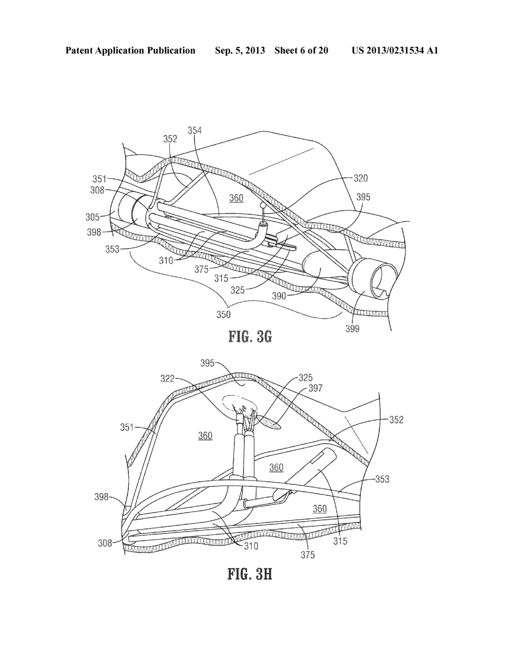 FLOATING, MULTI-LUMEN-CATHETER RETRACTOR SYSTEM FOR A MINIMALLY-INVASIVE,     OPERATIVE GASTROINTESTINAL TREATMENT - diagram, schematic, and image 07