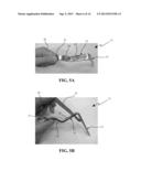 DEVICE AND METHOD FOR SAFELY EXPANDING MINIMALLY INVASIVE SURGICAL     INCISIONS diagram and image