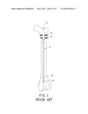 Support instrument with modular intramedullary nail diagram and image