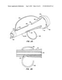 Tissue Separating Catheter Assembly and Method diagram and image