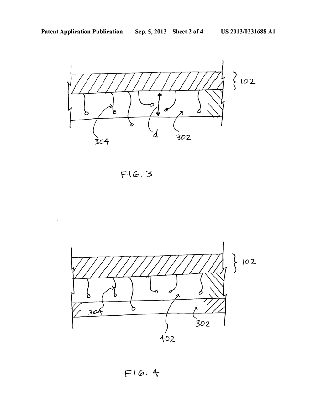 REINFORCEMENT DEVICE WITH DISSOLVABLE LAYER AND ITS USE - diagram, schematic, and image 03