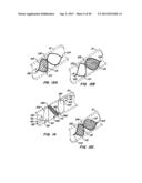 COATED ENDOLUMINAL FILTERS diagram and image