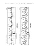 SYSTEMS AND METHODS OF CHARACTERIZING MECHANICAL ACTIVATION PATTERNS FOR     RHYTHM DISCRIMINATION AND THERAPY diagram and image