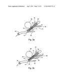 Implantable Graft Assembly and Aneurysm Treatment diagram and image