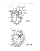 HYDRAULIC DELIVERY SYSTEMS FOR PROSTHETIC HEART VALVE DEVICES AND     ASSOCIATED METHODS diagram and image