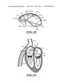 HYDRAULIC DELIVERY SYSTEMS FOR PROSTHETIC HEART VALVE DEVICES AND     ASSOCIATED METHODS diagram and image