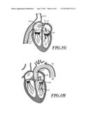 HYDRAULIC DELIVERY SYSTEMS FOR PROSTHETIC HEART VALVE DEVICES AND     ASSOCIATED METHODS diagram and image