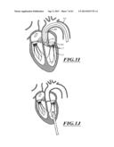 HYDRAULIC DELIVERY SYSTEMS FOR PROSTHETIC HEART VALVE DEVICES AND     ASSOCIATED METHODS diagram and image