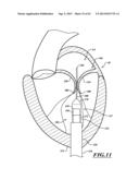 HYDRAULIC DELIVERY SYSTEMS FOR PROSTHETIC HEART VALVE DEVICES AND     ASSOCIATED METHODS diagram and image