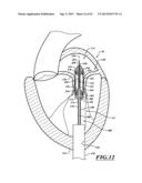 HYDRAULIC DELIVERY SYSTEMS FOR PROSTHETIC HEART VALVE DEVICES AND     ASSOCIATED METHODS diagram and image