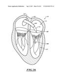 HYDRAULIC DELIVERY SYSTEMS FOR PROSTHETIC HEART VALVE DEVICES AND     ASSOCIATED METHODS diagram and image