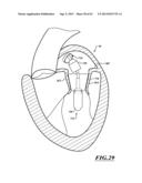 HYDRAULIC DELIVERY SYSTEMS FOR PROSTHETIC HEART VALVE DEVICES AND     ASSOCIATED METHODS diagram and image