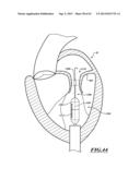 HYDRAULIC DELIVERY SYSTEMS FOR PROSTHETIC HEART VALVE DEVICES AND     ASSOCIATED METHODS diagram and image