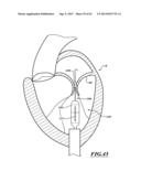 HYDRAULIC DELIVERY SYSTEMS FOR PROSTHETIC HEART VALVE DEVICES AND     ASSOCIATED METHODS diagram and image