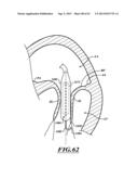 HYDRAULIC DELIVERY SYSTEMS FOR PROSTHETIC HEART VALVE DEVICES AND     ASSOCIATED METHODS diagram and image