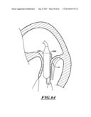 HYDRAULIC DELIVERY SYSTEMS FOR PROSTHETIC HEART VALVE DEVICES AND     ASSOCIATED METHODS diagram and image