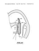 HYDRAULIC DELIVERY SYSTEMS FOR PROSTHETIC HEART VALVE DEVICES AND     ASSOCIATED METHODS diagram and image