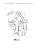 HYDRAULIC DELIVERY SYSTEMS FOR PROSTHETIC HEART VALVE DEVICES AND     ASSOCIATED METHODS diagram and image