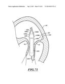 HYDRAULIC DELIVERY SYSTEMS FOR PROSTHETIC HEART VALVE DEVICES AND     ASSOCIATED METHODS diagram and image