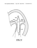 HYDRAULIC DELIVERY SYSTEMS FOR PROSTHETIC HEART VALVE DEVICES AND     ASSOCIATED METHODS diagram and image