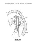 HYDRAULIC DELIVERY SYSTEMS FOR PROSTHETIC HEART VALVE DEVICES AND     ASSOCIATED METHODS diagram and image