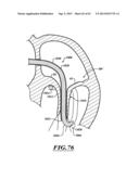 HYDRAULIC DELIVERY SYSTEMS FOR PROSTHETIC HEART VALVE DEVICES AND     ASSOCIATED METHODS diagram and image