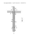 INTRA-ATRIAL IMPLANTS MADE OF NON-BRAIDED MATERIAL diagram and image