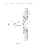 INTRA-ATRIAL IMPLANTS MADE OF NON-BRAIDED MATERIAL diagram and image