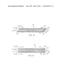 INTRA-ATRIAL IMPLANTS MADE OF NON-BRAIDED MATERIAL diagram and image