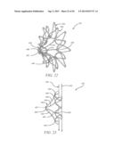 INTRA-ATRIAL IMPLANTS MADE OF NON-BRAIDED MATERIAL diagram and image