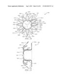 INTRA-ATRIAL IMPLANTS MADE OF NON-BRAIDED MATERIAL diagram and image