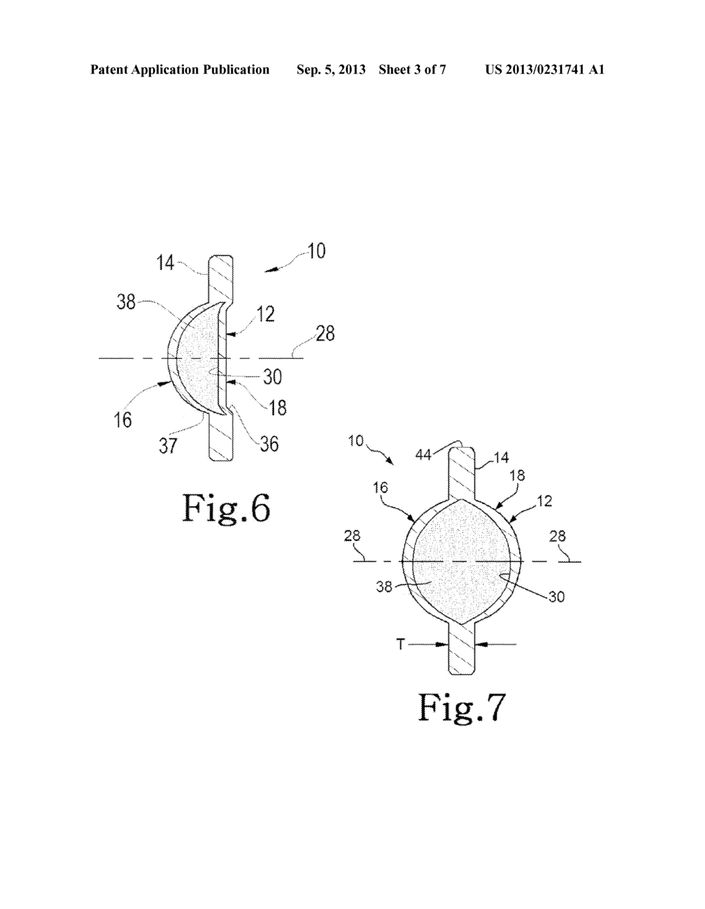 USE OF ACCOMMODATING INTRAOCULAR LENS - diagram, schematic, and image 04