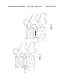 INTERVERTEBRAL IMPLANT diagram and image