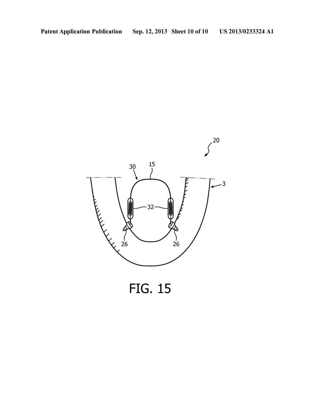 GLOSSOPLASTY IMPLANT TENSION RELIEF SYSTEM - diagram, schematic, and image 11