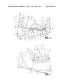 Sialendoscopy Demonstration Apparatus diagram and image