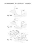 METHOD AND SYSTEM FOR PRODUCING AT LEAST ONE PATIENT-SPECIFIC SURGICAL AID diagram and image