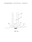 DEVICES AND METHODS FOR ASSISTING CARDIAC FUNCTION diagram and image