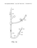 DEVICES AND METHODS FOR ASSISTING CARDIAC FUNCTION diagram and image