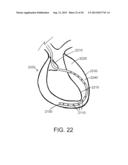 DEVICES AND METHODS FOR ASSISTING CARDIAC FUNCTION diagram and image